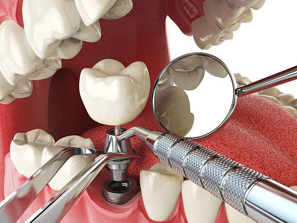 Best Emergency Treatment for Oral Infections in Emerd Mountain, AL